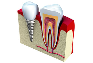 imagem implantes dentários